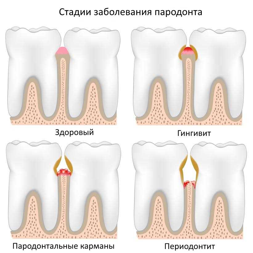 Стадии заболевания пародонта