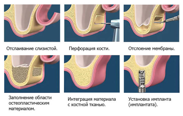 Костная пластика в Липецке