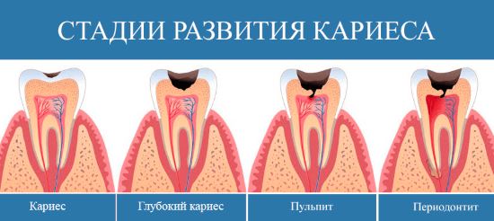 последствия пульпита зуба