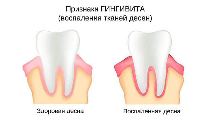 Почему нельзя пренебрегать визитом к пародонтологу