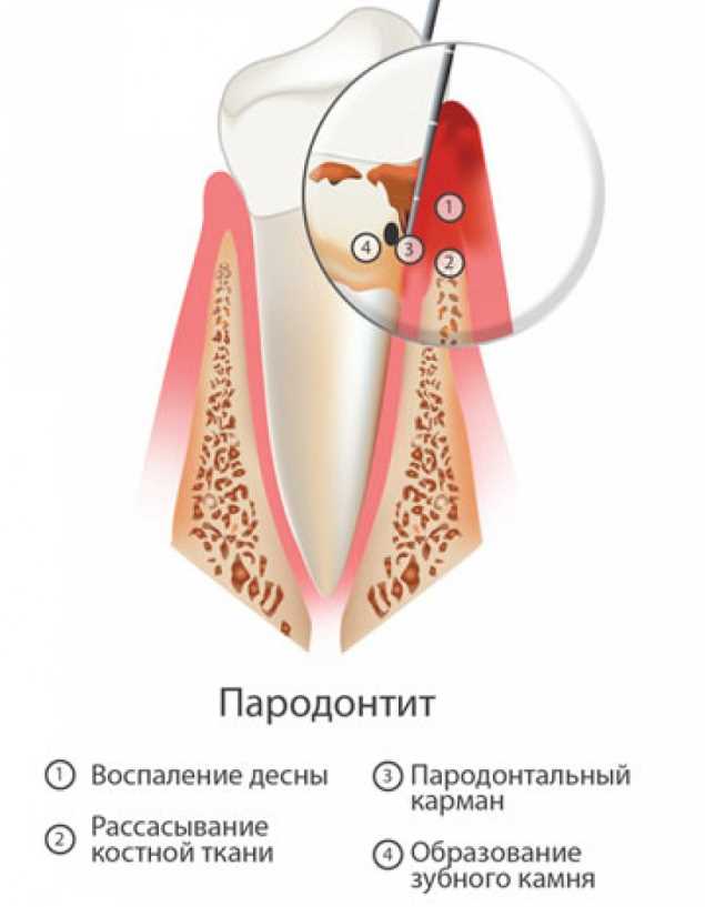 лечение Пародонтита