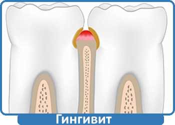 гингивит