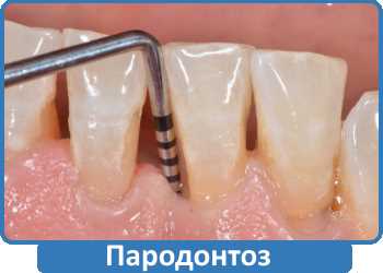 Пародонтоз