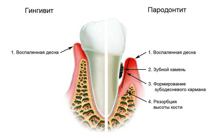 Воспаление десен