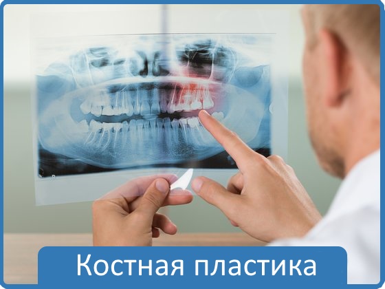 Костная пластика - трансплантация костной ткани с целью замещения дефектов кости.